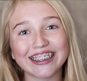 braces diagram